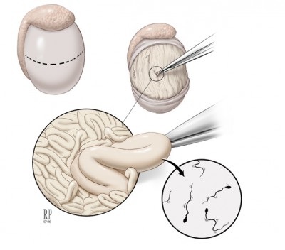 Sperm removal for ivf