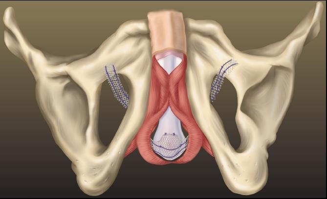 Urethral Sling Surgery: What to Expect at Home