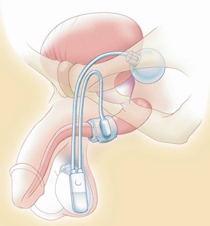 Urinary incontinance21